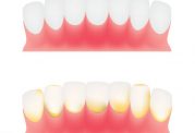 5 نکته شگفت انگیز برای  از بین بردن پلاک دندان