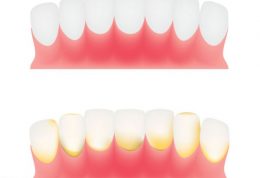 5 نکته شگفت انگیز برای  از بین بردن پلاک دندان