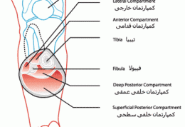 جزئیاتی در خصوص سندروم کمپارتمان مزمن