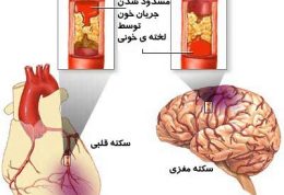 ژن PIA2  ایجادکننده سکته مغزی و قلبی