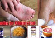 15 درمان خانگی برای قارچ پای ورزشکاران
