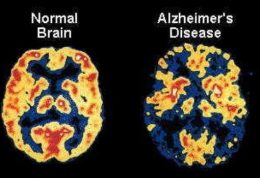 بهبود آلزایمر با روزه