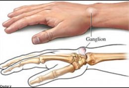 همه چیز درباره کیست سینوویال مچ دست