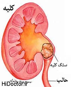 تغییرمیزان و حجم سنگ کلیه با این کارها