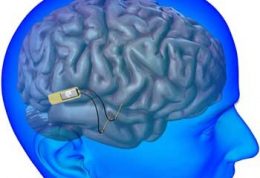 بازگرداندن حافظه با یک ایمپلنت مغزی