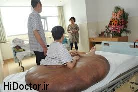 index.jpgبلی بزرگترین تومور جهان با وزن صد و ده کیلو