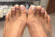 انگشتان پای زیبا و کوچک با جراحی!