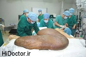 index8 بزرگترین تومور جهان با وزن صد و ده کیلو