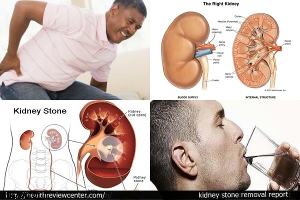 kidney stone removal report خطر سنگ کلیه با این علائم شما را تهدید می کند