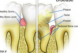 هر آنچه که باید درباره  بیماری‌های بافت نگه‌دارنده دندان و سلامت عمومی بدانید
