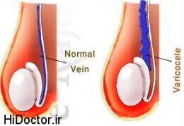 درمان بیماری واریکوسل از نوجوانی امکان پذیر است