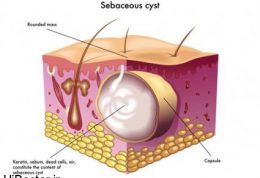درباره کیست سباسه چه میزان اطلاع دارید