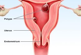 پلیپ رحم را با تغذیه کنترل کنید