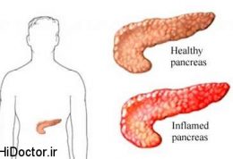 جلوگیری از  پانکراتیت حاد با انسولین