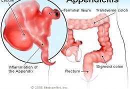 هشدار آپاندیسیت برای بدن با این نشانه ها