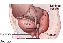 رهایی از مشکلات ادراری ناشی از  بزرگی پروستات در مردان