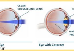 درمان ناراحتی مادرزادی چشمی با لنز
