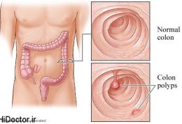 درباره انواع پولیپ ها و درمان آنها بیشتر بدانید