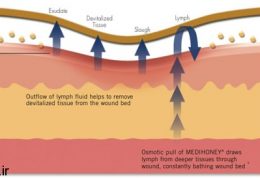 به زخم ها و خراشیدگی هایتان ضماد عسل بمالید