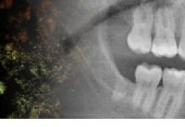 باکتریهای دهان در هنگام بیماری متابولیسم را تغییر میدهد