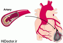 نیم ساعته متوجه حمله قلبی در افراد شوید