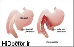 انسولین  شیوه ای جدید  برای معالجه پانکراتیت حاد