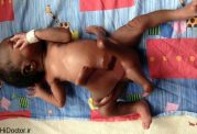 بیماری نادر و وحشتناک این نوزاد هنگام تولد