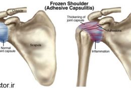 شانه منجمد (یخ زدگی شانه) چه بیماری است؟