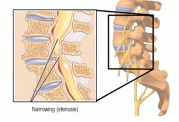 رابطه  درد کمر با مشکل در کانال نخاعی  