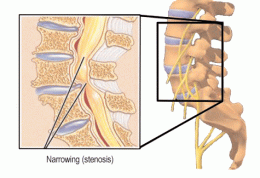رابطه  درد کمر با مشکل در کانال نخاعی