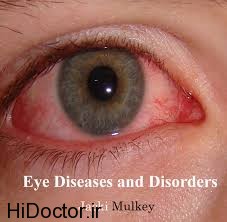 امراض مختلف با علائم چشمی