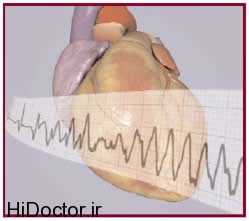 تایم سکته قلبی را بدانید