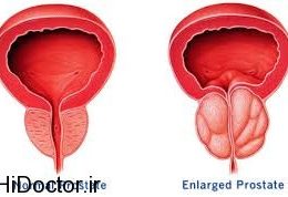 سیر تا پیاز پروستات