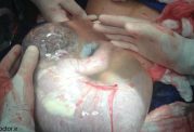 تولد زودرس این جنین در کیسه آب