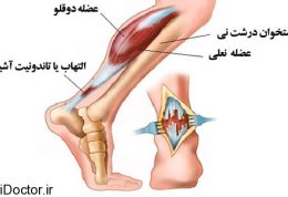 اطلاعاتی در مورد زردپی – تورم و التهاب تاندون