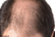 مردان کم مو در معرض سرطان اند