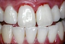 رسوب دندان منجر به این بیماری می شود