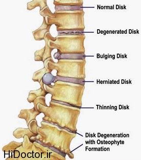 سلامت و ارامش دیسک کمر با این کارها