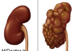 با کیست کلیه چه کنیم