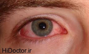 تاثیر عوامل ژنتیکی در بینایی افراد