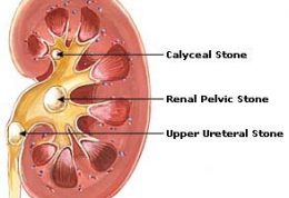 منع مصرف کلسیم به خاطر سنگ کلیه اشتباه است!
