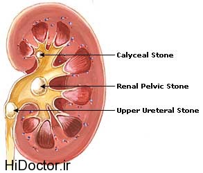 pics of kidney stones in urine