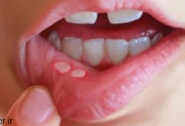آیا آفت دهان به علت کمبود ویتامین است
