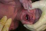 عکس نوزادی که در هنگام تولد دو دندان داشت