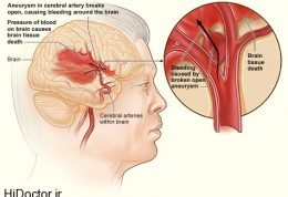 تازه ترین نتایج محققین درباره سکته از نوع مغزی