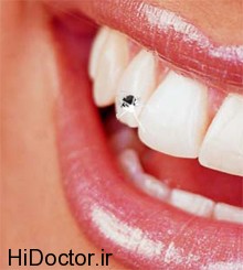 مضرات و عواقب استفاده از نگین برای دندان