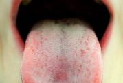سرطان روی زبان چه نشانه هایی دارد؟