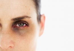 تیرگی اطراف چشم را بطور موثر از بین ببرید