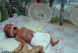 آمار رو به بالای تولد زودهنگام جنین های ایرانی
