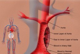 آسیب به سرخرگ آئورت با آنفلوآنزا